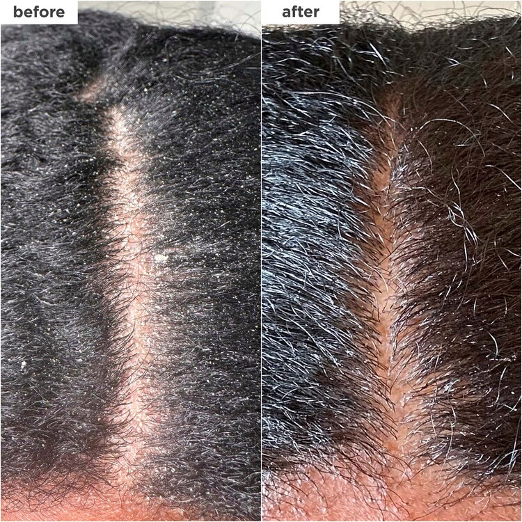 Scalp Revival™ MegaStrength+ - Shampooing antipelliculaire Charbon + AHA/BHA