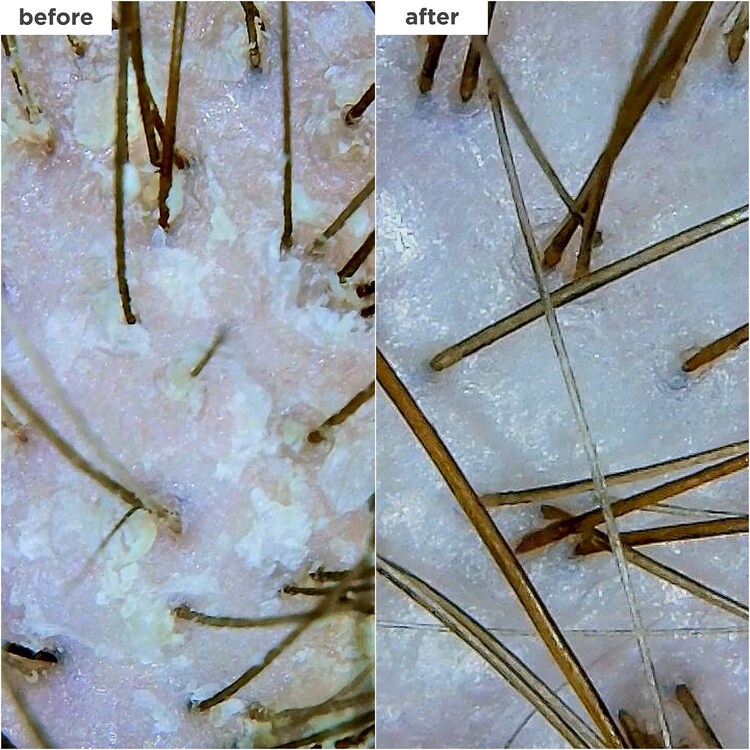 Scalp Revival™ MegaStrength+ - Shampooing antipelliculaire Charbon + AHA/BHA