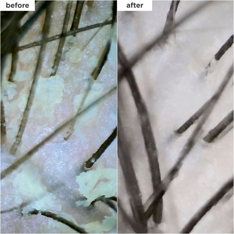 Scalp Revival™ MegaStrength+ - Shampooing antipelliculaire Charbon + AHA/BHA