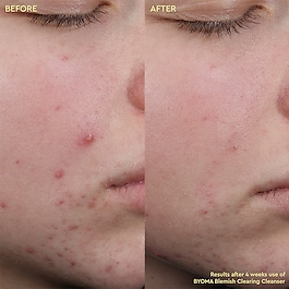 Blemish Clearing Cleanser - Detergente anti-imperfezioni