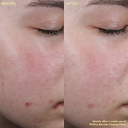 Blemish Clearing Paste- Pâte anti-imperfections