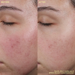 Blemish Control Moisturizer - Crema idratante anti-imperfezioni