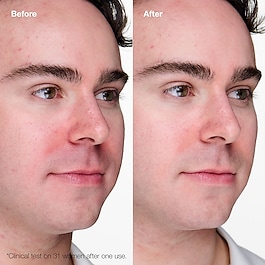 Anti-Blemish Solutions™ - Gel Anti-imperfections +