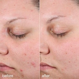 Age Bright Clearing Serum - Anti-blemish