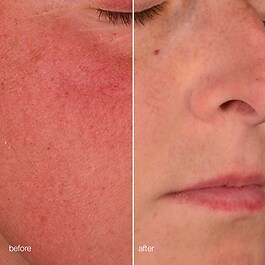 Retinol Clearing Oil