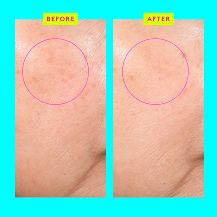 Bouncy Brightfacial™ - Masque Visage Illuminateur