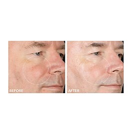 Alpha Beta® - Peel Extra Strength