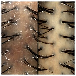 Amino - mousse pour le traitement du cuir chevelu