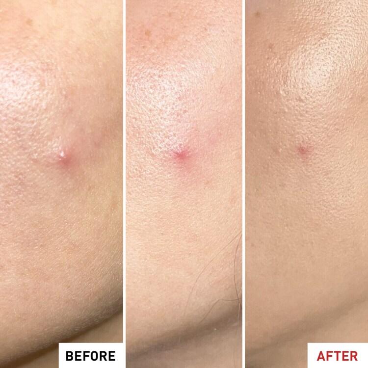 Centella SOS Patch - Gel Effet Patch