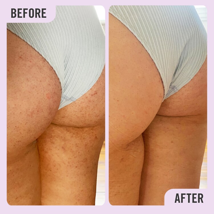 KP Bump Eraser Body Scrub with 10% AHA - Exfoliant Corporel aux AHA