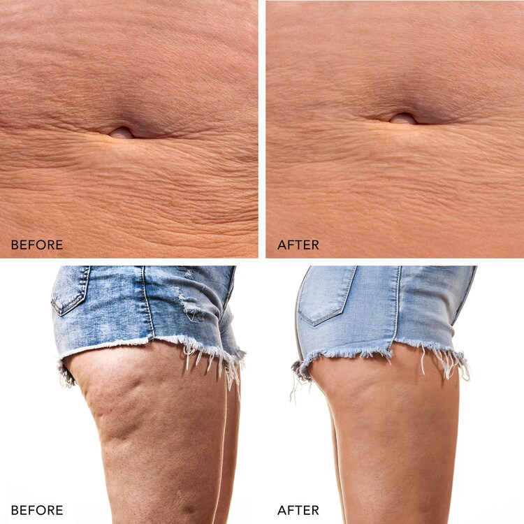 BEAR™ 2 body - Mikroprądowe urządzenie ujędrniające do ciała