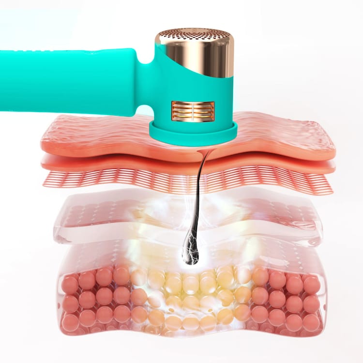 PEACH™ 2 Set - Bezbolesny zabieg usuwania włosów IPL