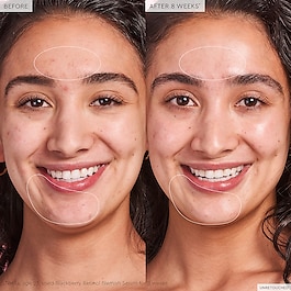Blackberry Retinol - Blemish Serum