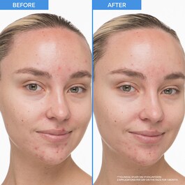 Sérum Doux au Rétinol et Acide Salicylique - Sérum Anti-Imperfections