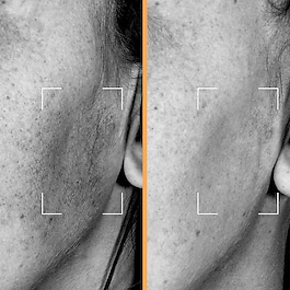 Protocole Brightening