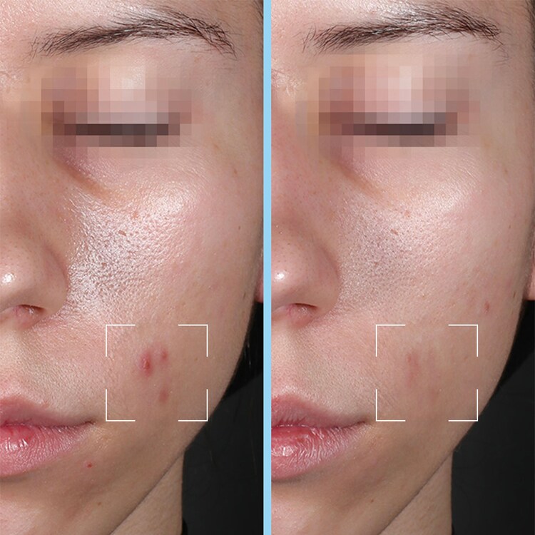 Routine purifiante - Appareil LED et Capsules Purity