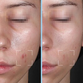 C&aacute;psulas Purity - S&eacute;rum antimperfecciones enriquecido con &Aacute;cido salic&iacute;lico y AH