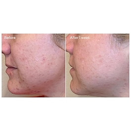 Daily Clarifying Peel