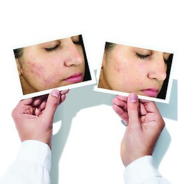 Blemish control - Invisiscar Resurfacing Treatment