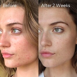 InvisiScar Resurfacing Treatment - Kuracja na blizny potrądzikowe