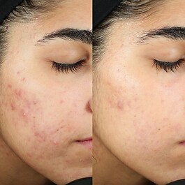 InvisiScar Resurfacing Treatment - Kuracja na blizny potrądzikowe