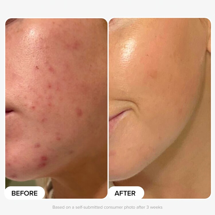 Routine Peau Nette & Éclat
