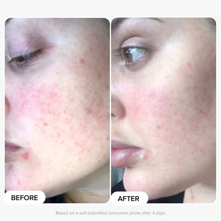 Routine Peau Nette & Éclat