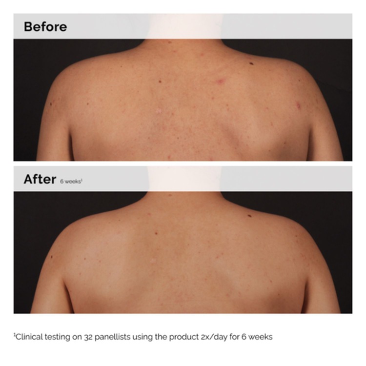 Sérum Corps à l'Acide Salicylique 0.5%  - Sérum Anti-imperfections pour le corps