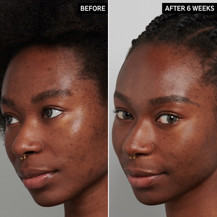 Trattamento notte all'acido traxenamico 