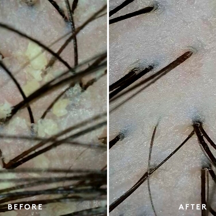 Scalp Remedy - Σαμπουάν Virtue®