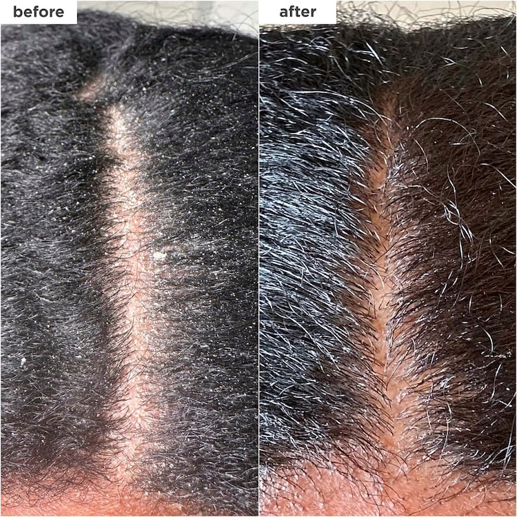 Scalp Revival™ MegaStrength+ - Shampooing antipelliculaire Charbon + AHA/BHA
