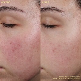 Blemish Control Moisturizer - Hidratantna krema protiv akni
