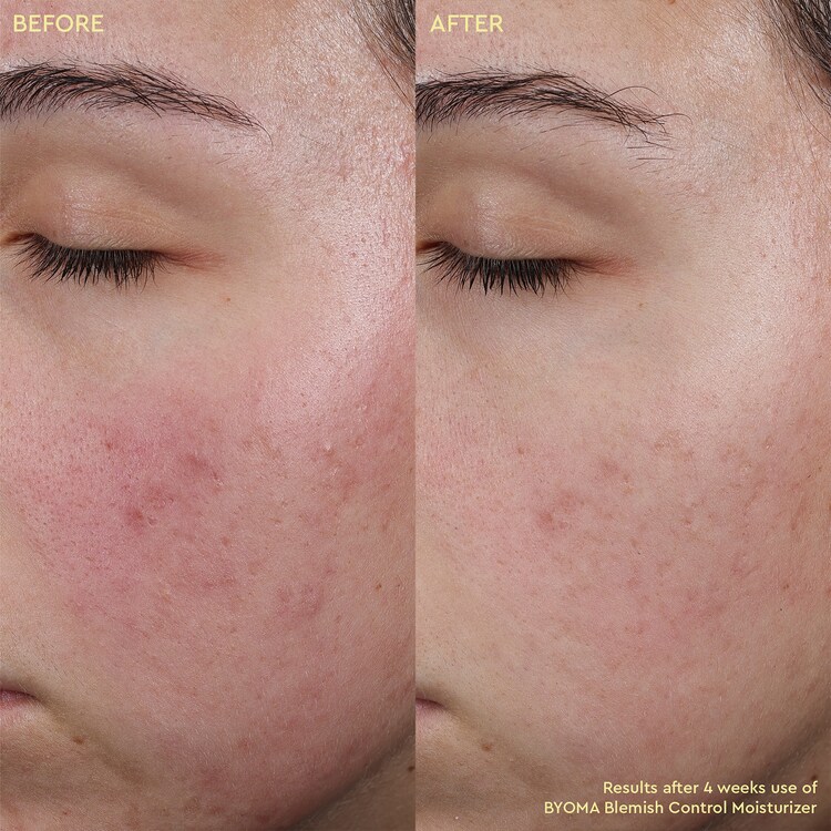 Blemish Control Moisturizer - Crema hidratante antimperfecciones