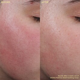 Redness Relief Soothing Toner - Akne i nepravilnosti