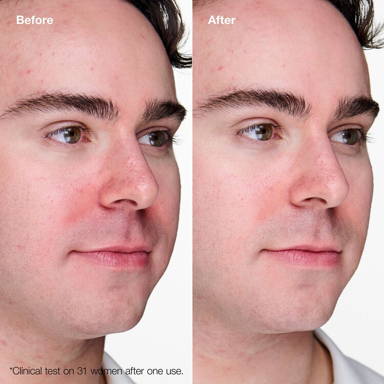 Anti-Blemish Solutions Clinical™ Advanced Clearing Gel - Gel