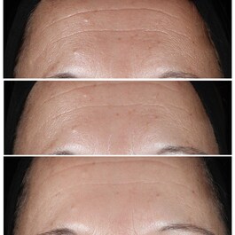 Smart Clinical Repair&trade; - Serum za korekciju bora