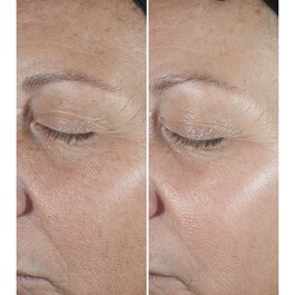 Smart Clinical Repair&trade; - Serum za korekciju bora