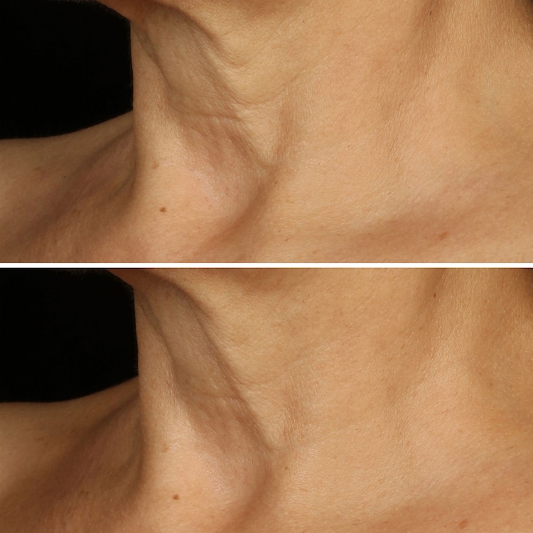 Smart Clinical Repair Lifting Face + Neck Cream - Micro-Lift Moisturizer 