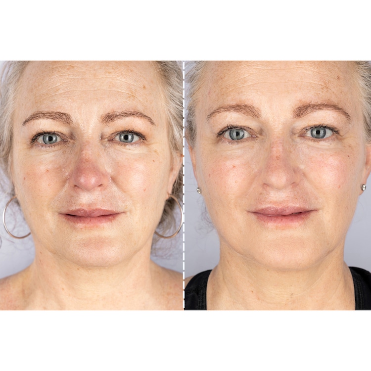 LED Light Therapy Face Mask Series 1 - LED Işık Terapisi Yüz Maskesi Serisi 1