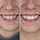 Teeth Whitening Kit - Diş Beyazlatma Kiti