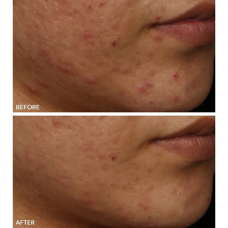 FaceWare Pro - Mascarilla Facial LED