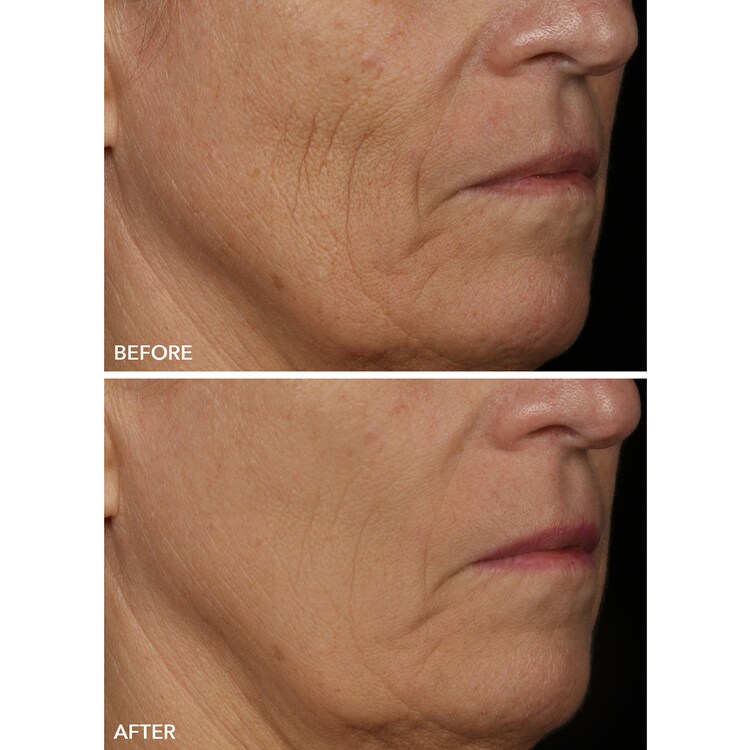 FaceWare Pro - Mascarilla Facial LED