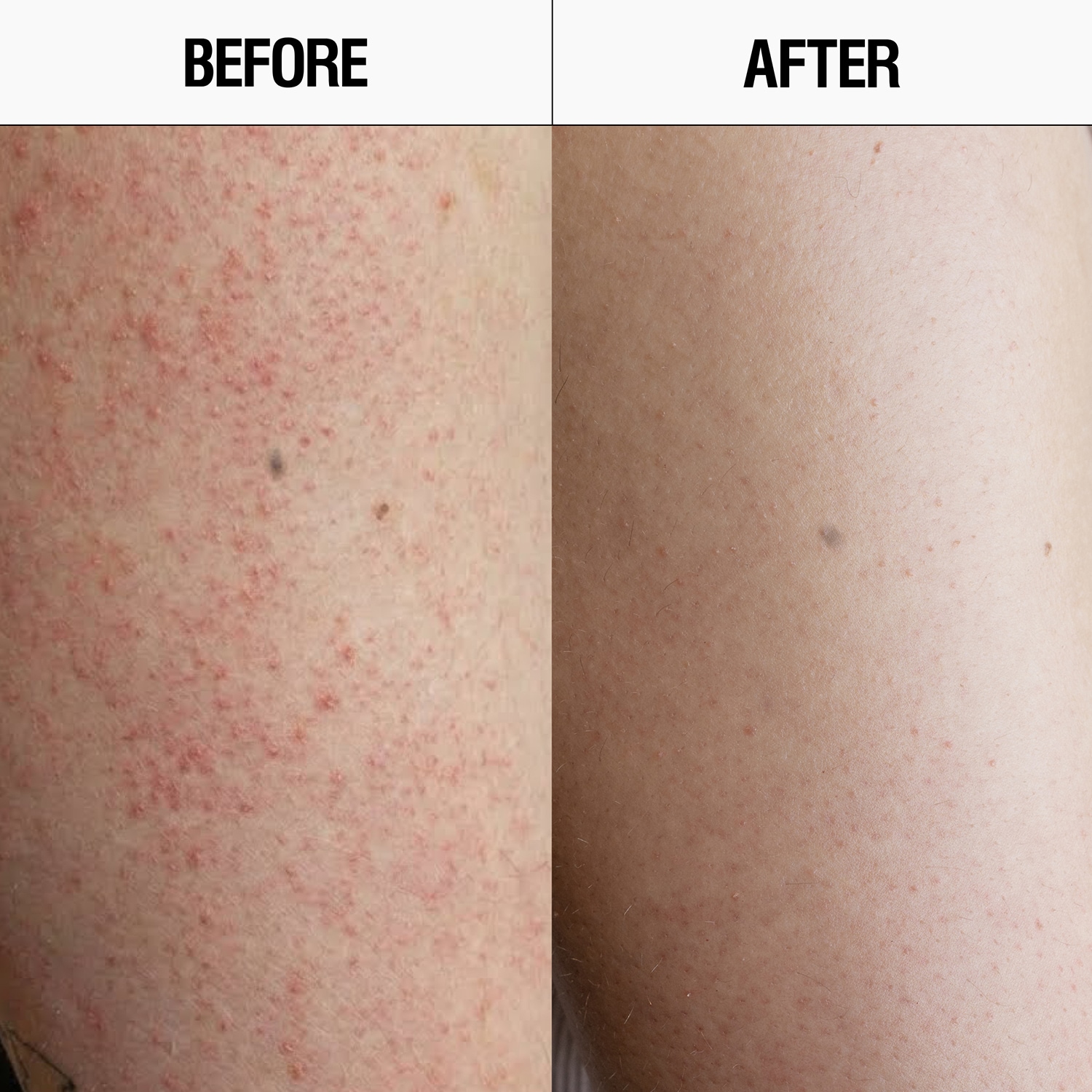 Resurfacing Targeted Body Cleanser AHA + BHA