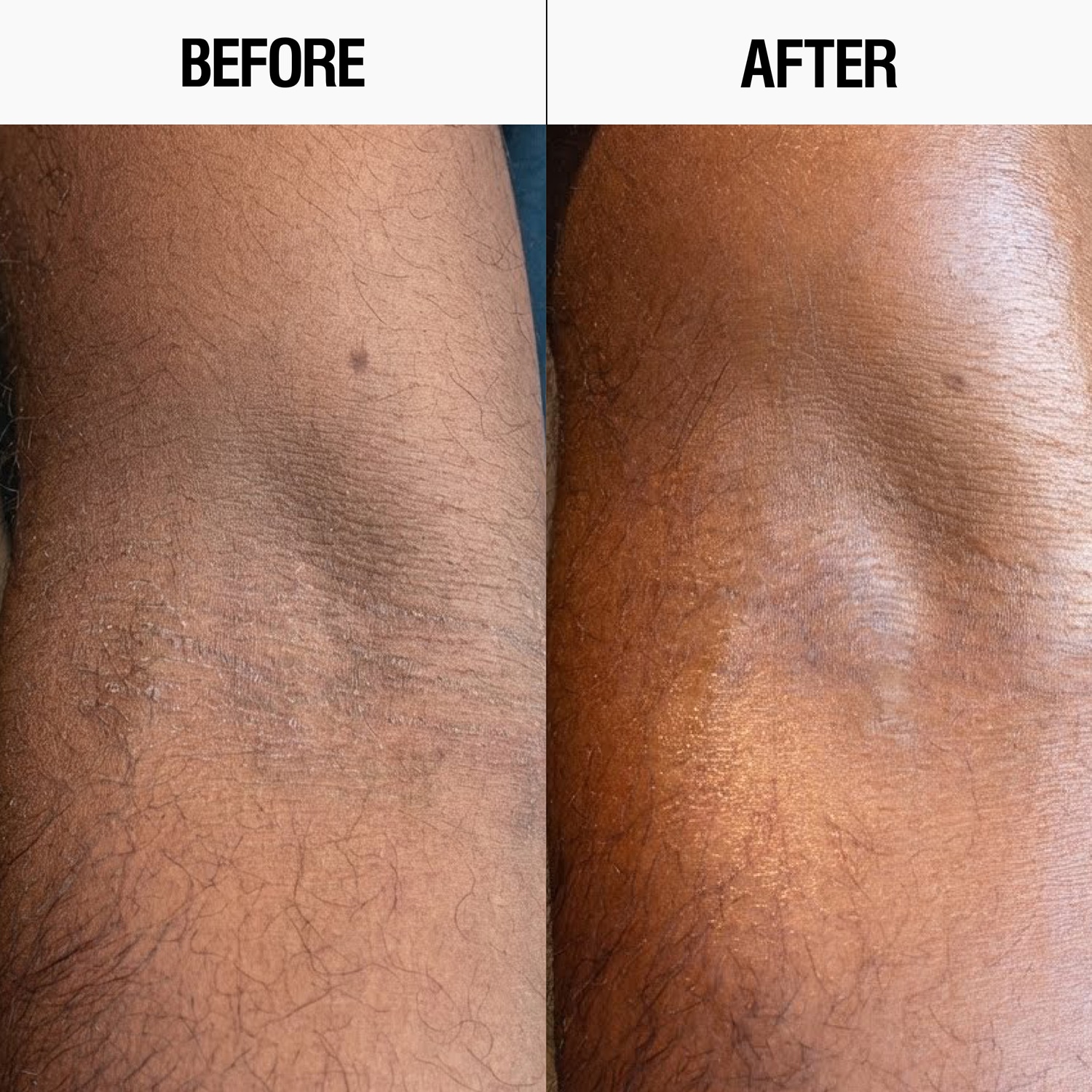 Resurfacing Targeted Body Lotion AHA + BHA