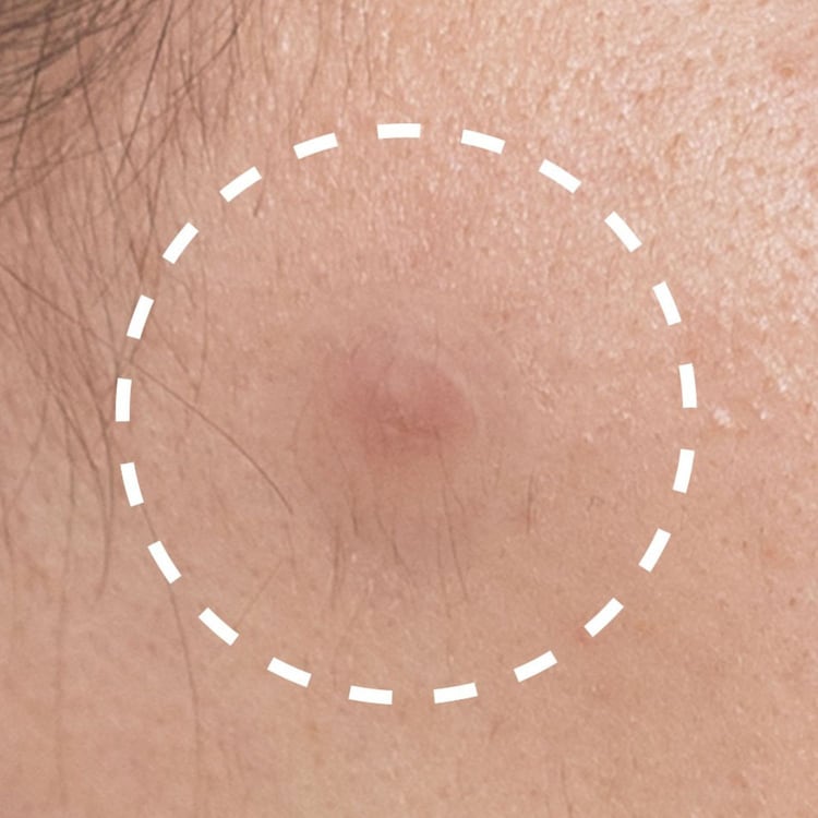 TT 8H Acne-Clearing Patch P22 - Επιδέσμους για τις ατέλειες