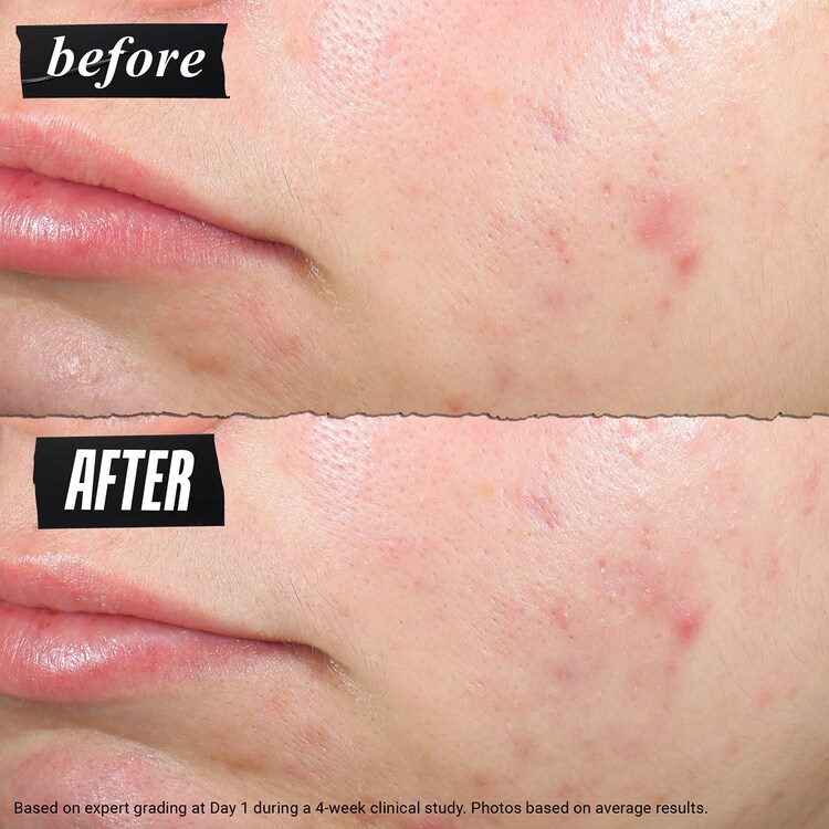 Truly Targeted Blemish Clearing Solution - Solution Ciblée Anti-Imperfections