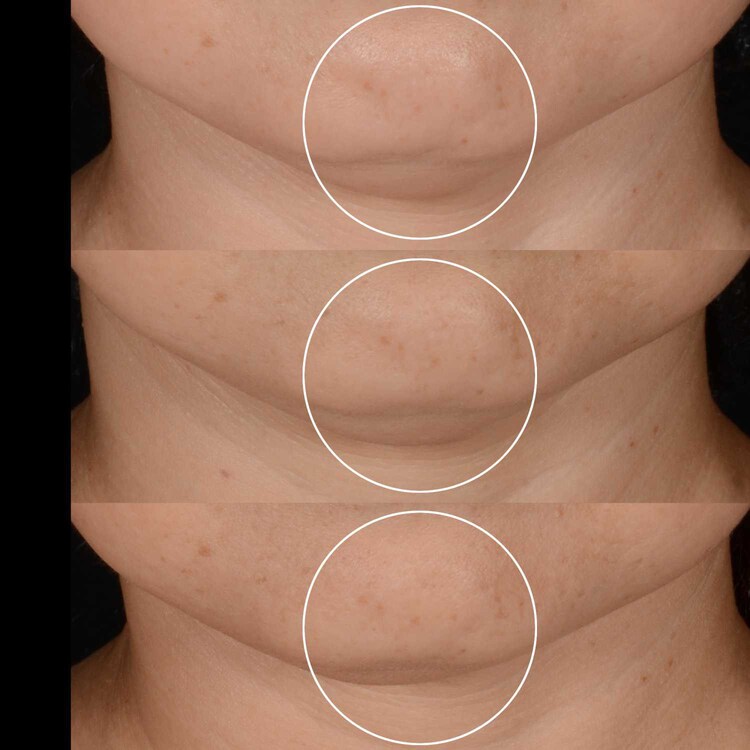 Renergie HPN 300 Cream - Dárková sada