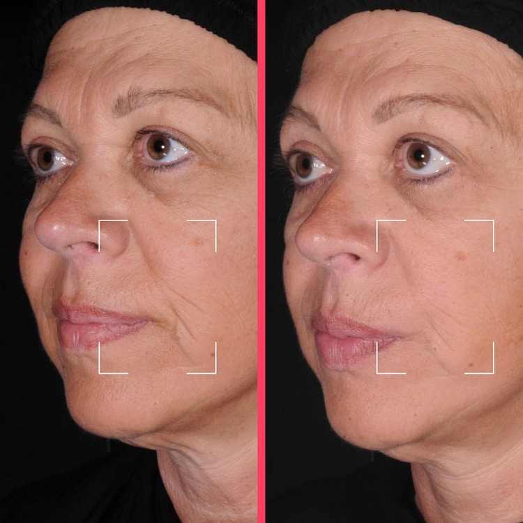 Routine anti-âge - Appareil LED et Capsules Lift