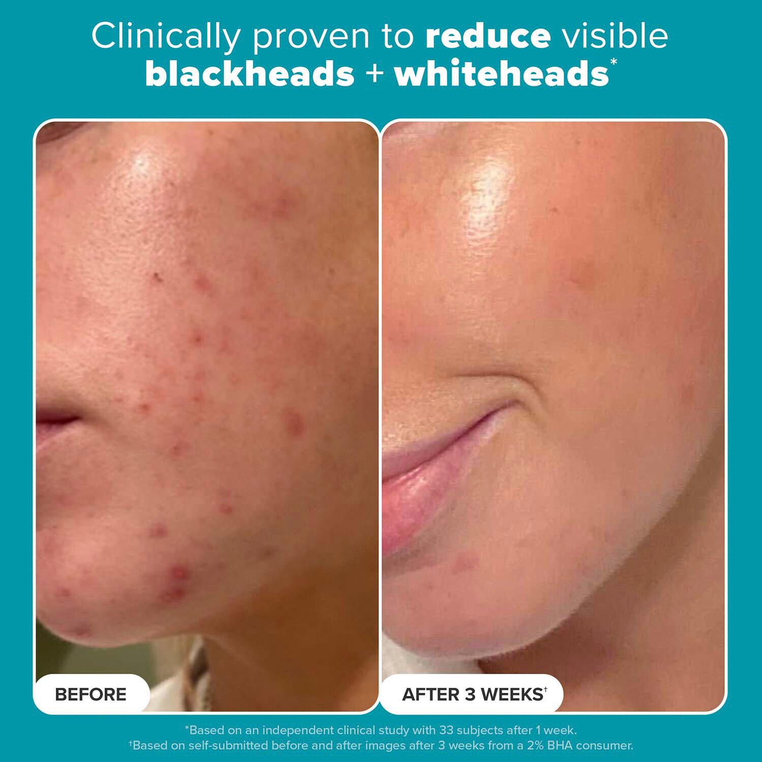 Skin Perfecting 2% BHA Exfoliating Toner