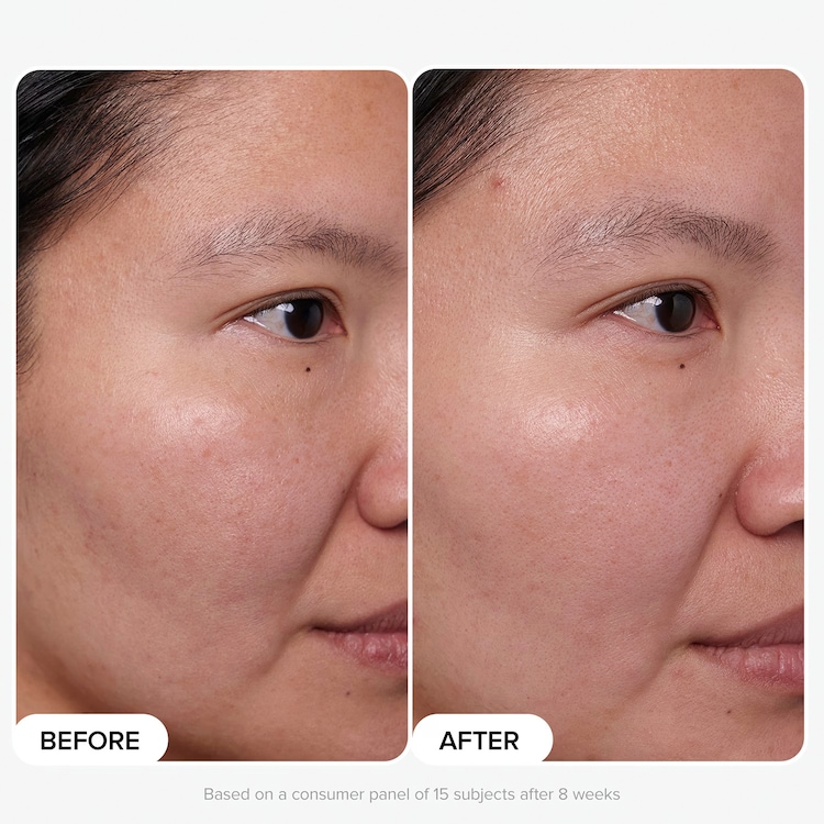 Clinical - Serum z 20% niacynamidu